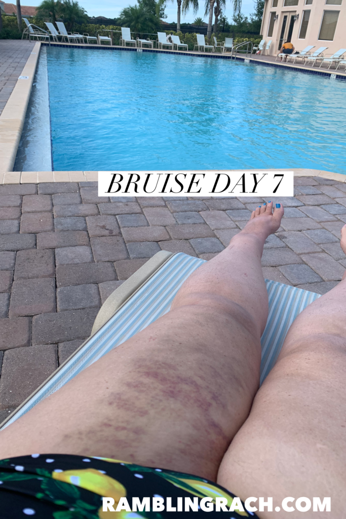 Timeline of a bruise after falling in the bathtub day 7