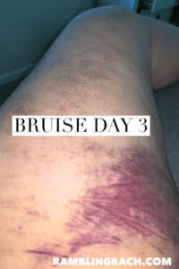 Timeline of a bruise after falling in the bathtub day 3