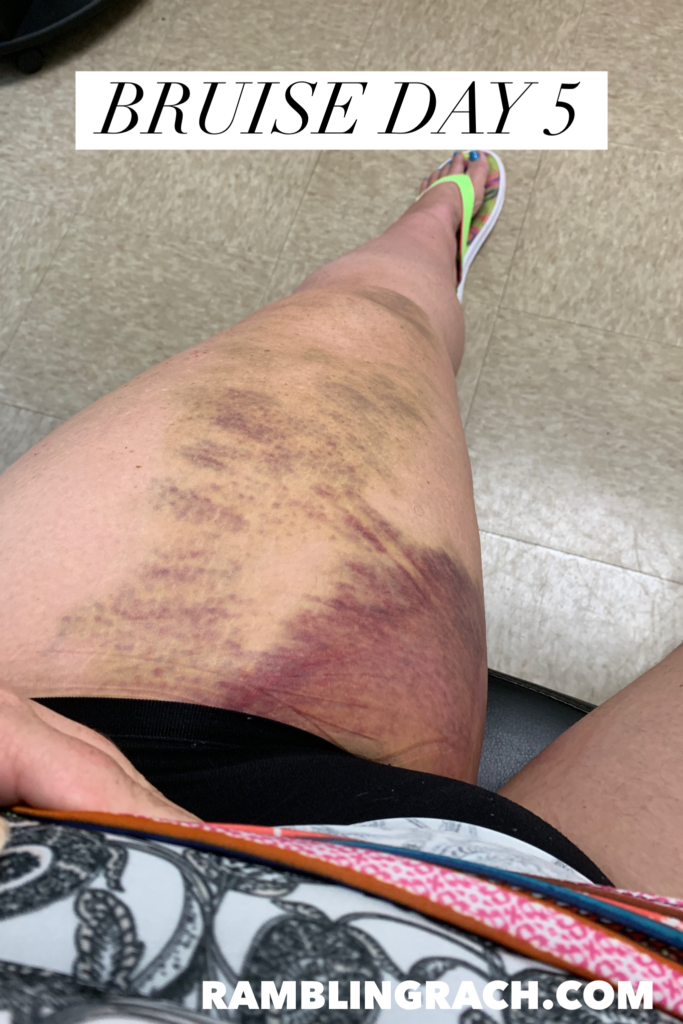 Timeline of a bruise after falling in the bathtub day 5
