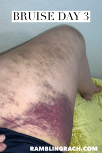 Timeline of a bruise after falling in the bathtub day 3