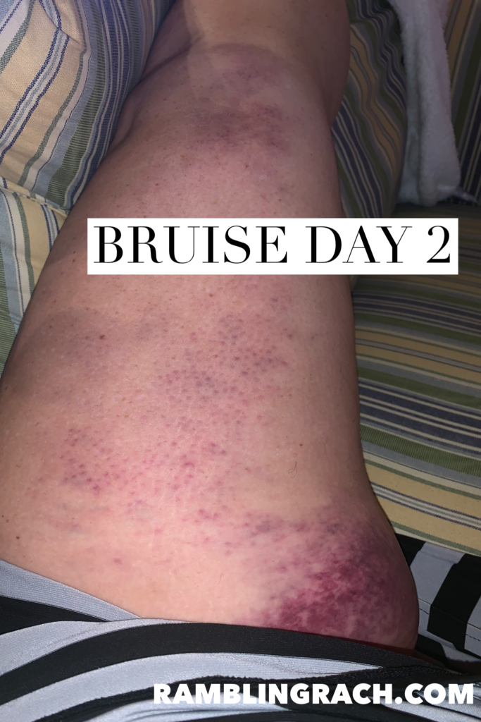 Timeline of a bruise after falling in the bathtub day 2