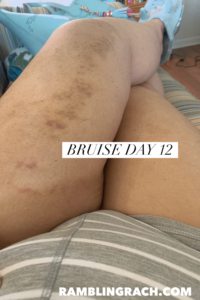 Timeline of a bruise after falling in the bathtub day 12