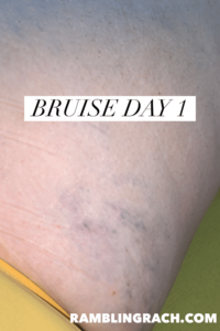 Timeline of a bruise after falling in the bathtub day 1.