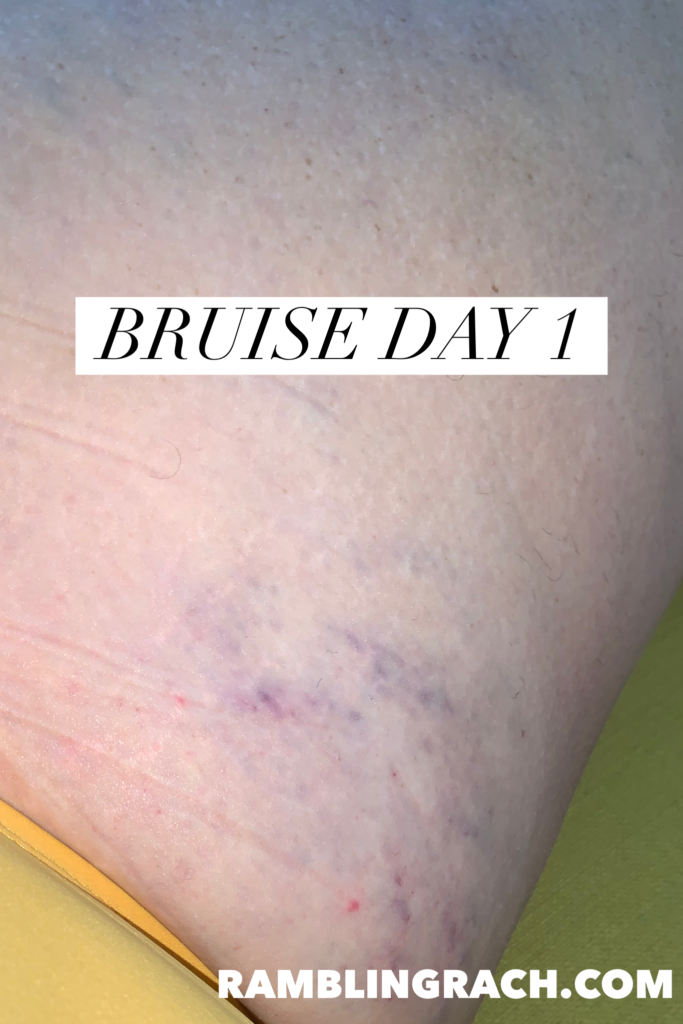 Timeline of a bruise after falling in the bathtub day 1.